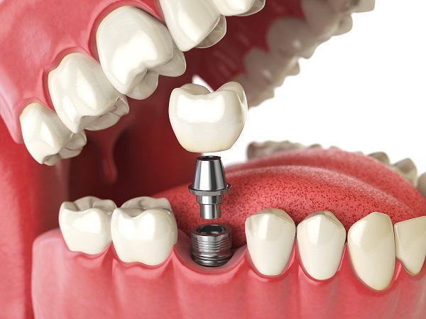 Fixed or Removable Implant Dentures - Which Is Right for Me?