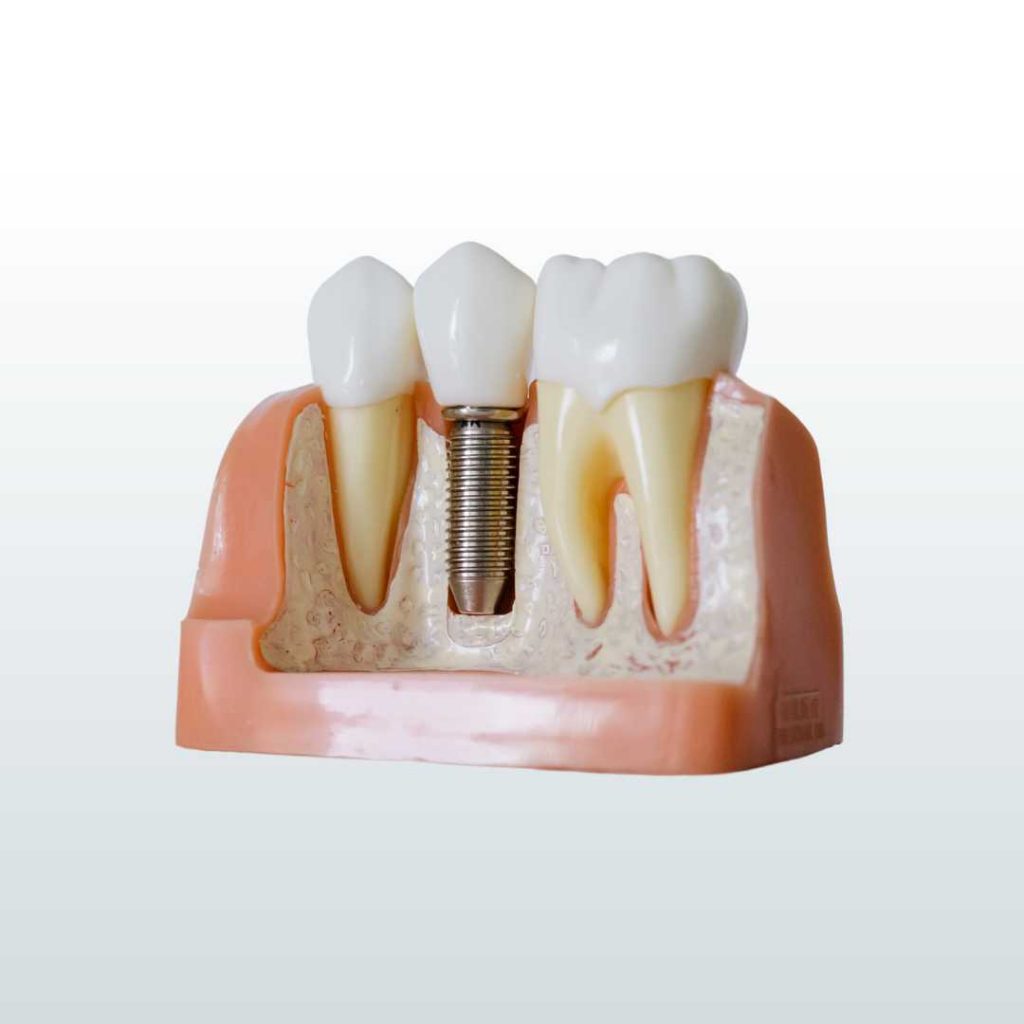 implant dentures calgary sw