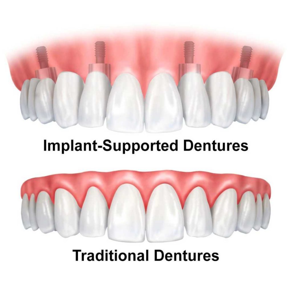 implant dentures in calgary