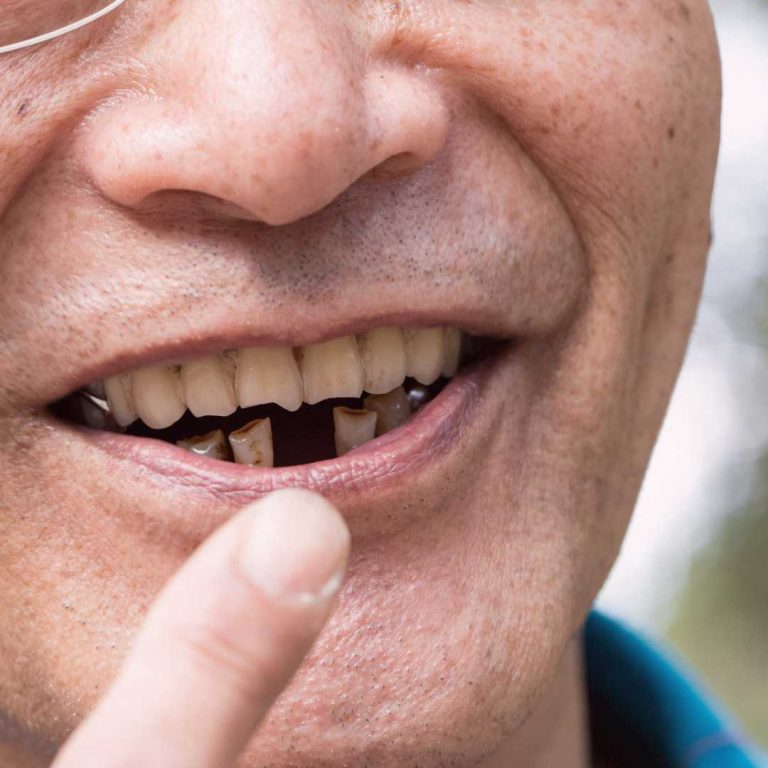 missing teeth dentures calgary