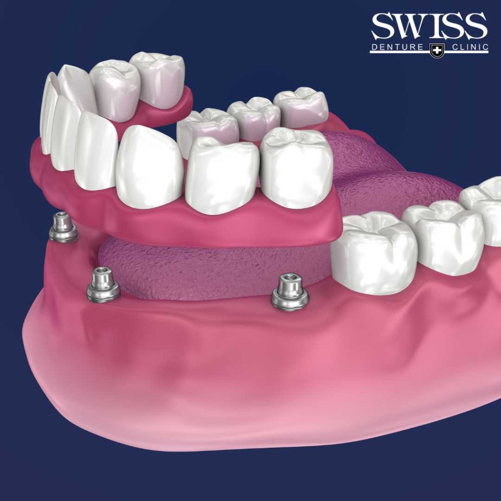 implant-dentures-calgary-swiss-denture