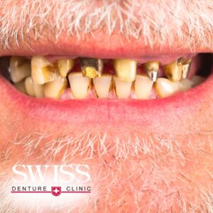 damaged-teeth-denture-clinic-calgary-swiss-dentures