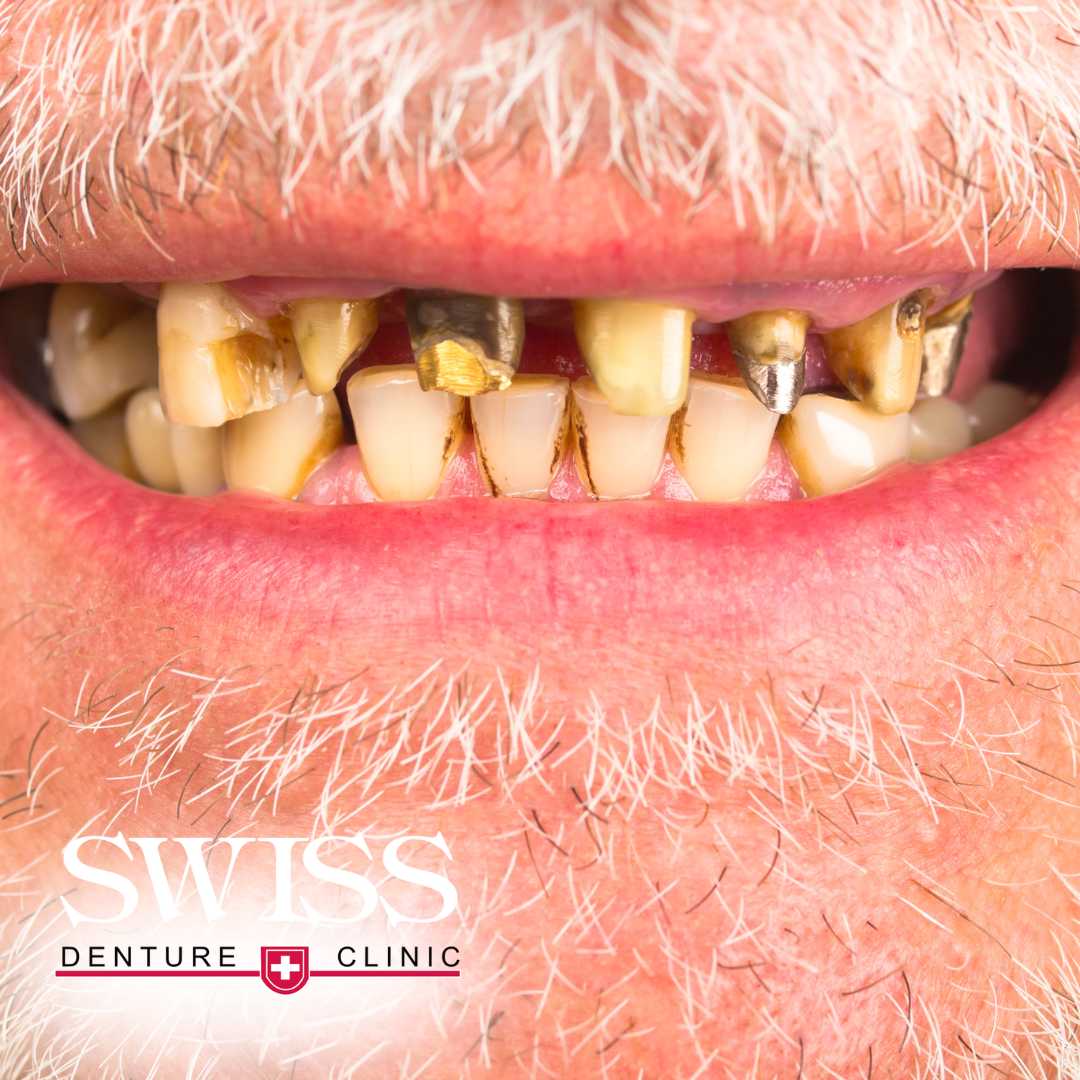 damaged-teeth-denture-clinic-calgary-swiss-dentures