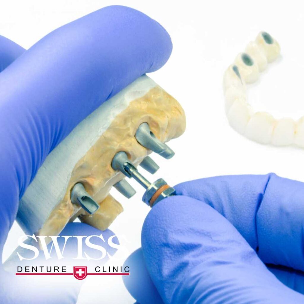 implant-supported-dentures-clinic-calgary-swiss-dentures